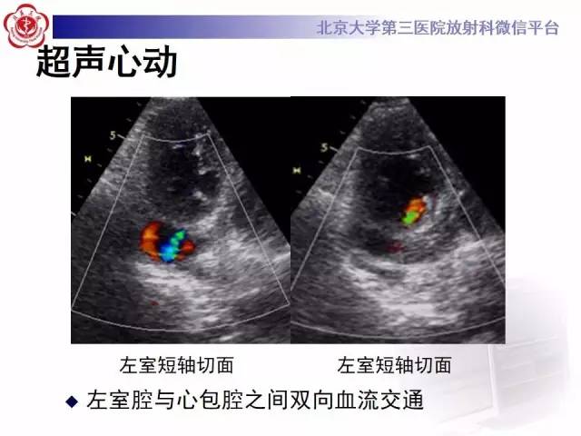 【病例】假性室壁瘤1例MR影像表现
