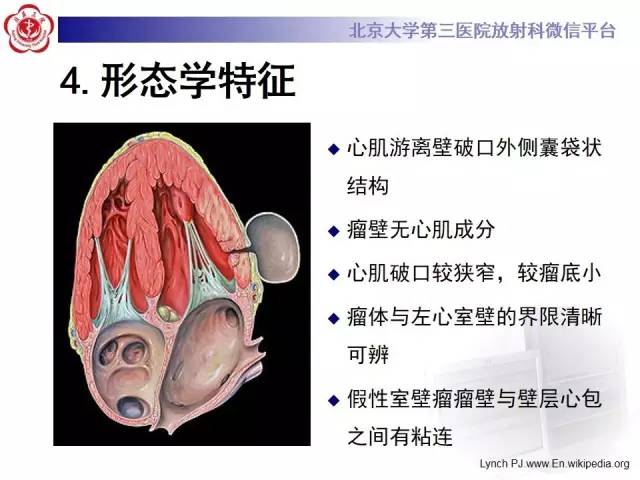 【病例】假性室壁瘤1例MR影像表现