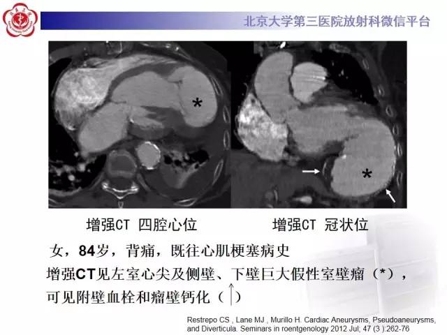 【病例】假性室壁瘤1例MR影像表现
