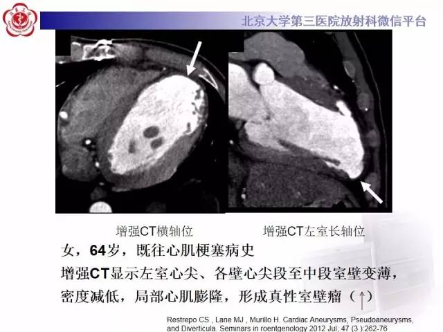 【病例】假性室壁瘤1例MR影像表现