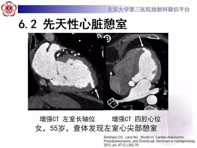 【病例】假性室壁瘤1例MR影像表现