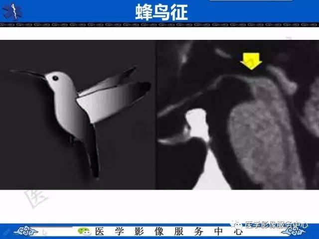 【影像征象】蜂鸟征