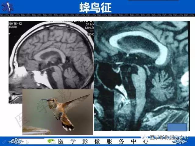【影像征象】蜂鸟征
