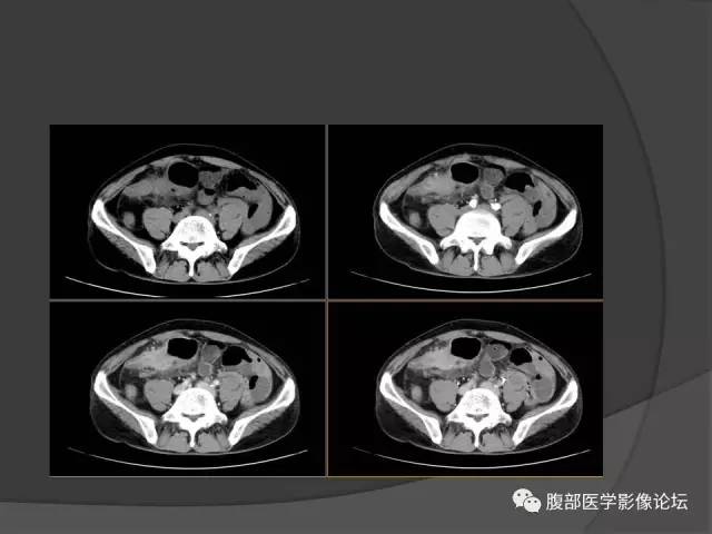 【病例】回肠、盲肠及阑尾结核1例CT 【病例】回肠、盲肠及阑尾结核1例CT