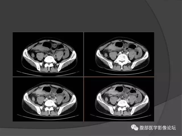 【病例】回肠、盲肠及阑尾结核1例CT 【病例】回肠、盲肠及阑尾结核1例CT
