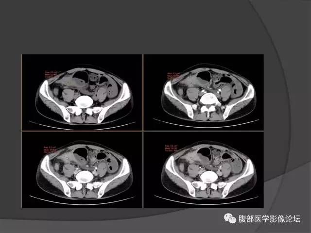 【病例】回肠、盲肠及阑尾结核1例CT 【病例】回肠、盲肠及阑尾结核1例CT