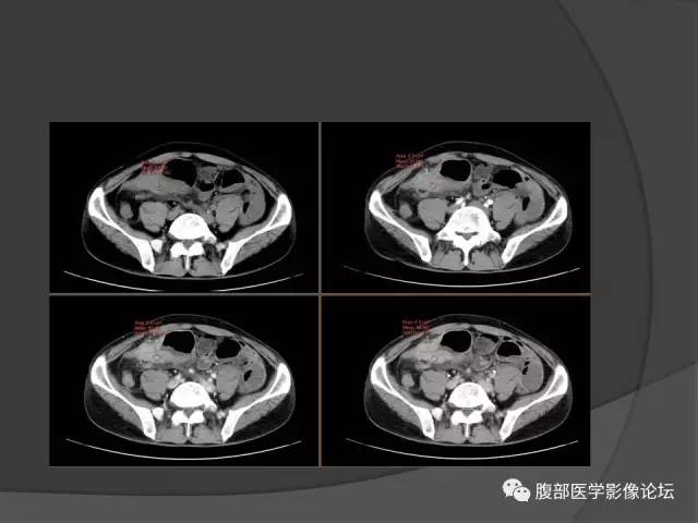【病例】回肠、盲肠及阑尾结核1例CT 【病例】回肠、盲肠及阑尾结核1例CT
