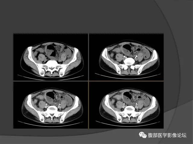 【病例】回肠、盲肠及阑尾结核1例CT 【病例】回肠、盲肠及阑尾结核1例CT
