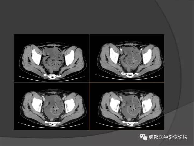 【病例】回肠、盲肠及阑尾结核1例CT 【病例】回肠、盲肠及阑尾结核1例CT
