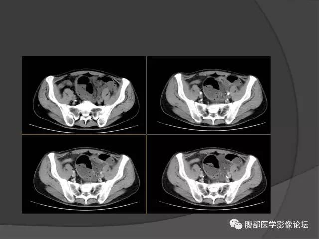 【病例】回肠、盲肠及阑尾结核1例CT 【病例】回肠、盲肠及阑尾结核1例CT
