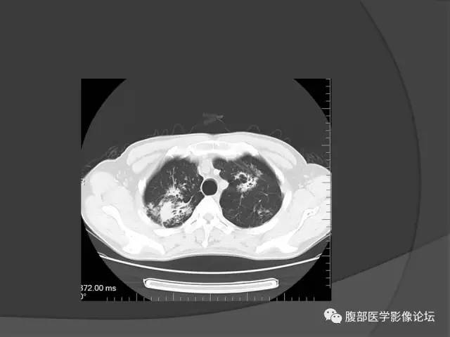 【病例】回肠、盲肠及阑尾结核1例CT 【病例】回肠、盲肠及阑尾结核1例CT