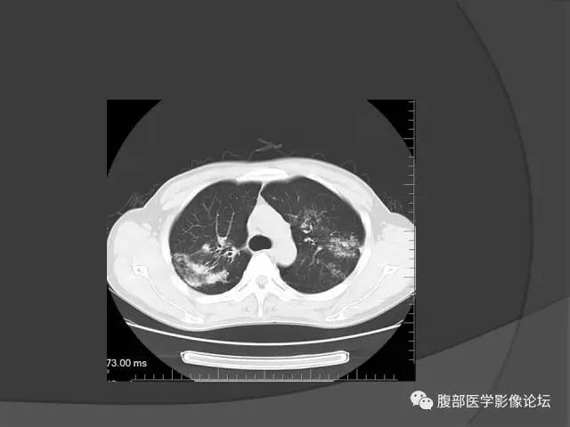 【病例】回肠、盲肠及阑尾结核1例CT 【病例】回肠、盲肠及阑尾结核1例CT