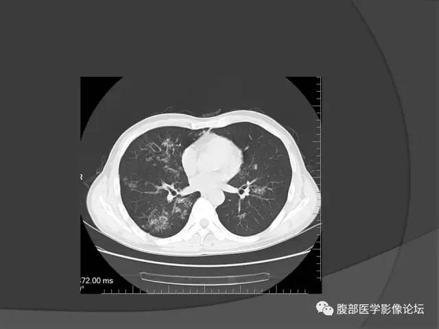 【病例】回肠、盲肠及阑尾结核1例CT 【病例】回肠、盲肠及阑尾结核1例CT