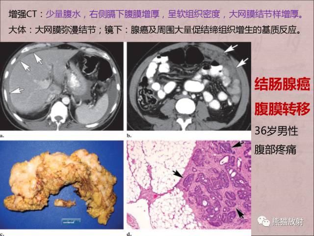 【PPT】腹膜腔继发性肿瘤及肿瘤样病变影像表现