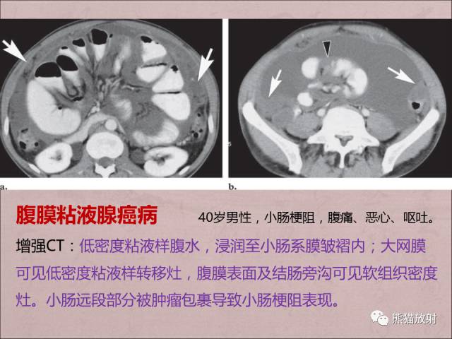 【PPT】腹膜腔继发性肿瘤及肿瘤样病变影像表现