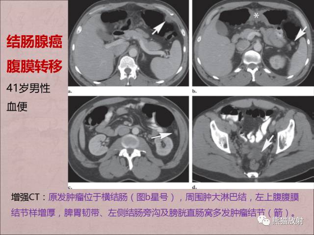 【PPT】腹膜腔继发性肿瘤及肿瘤样病变影像表现