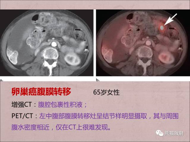 【PPT】腹膜腔继发性肿瘤及肿瘤样病变影像表现