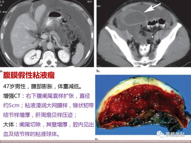 【PPT】腹膜腔继发性肿瘤及肿瘤样病变影像表现