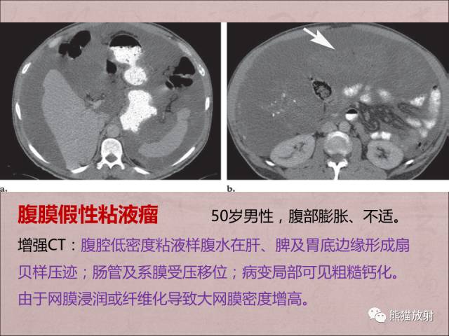 【PPT】腹膜腔继发性肿瘤及肿瘤样病变影像表现