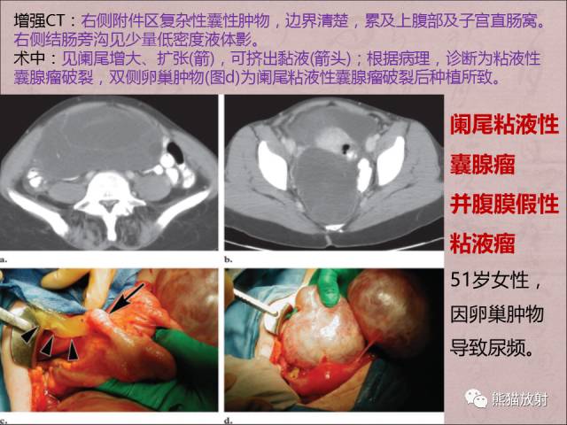 【PPT】腹膜腔继发性肿瘤及肿瘤样病变影像表现