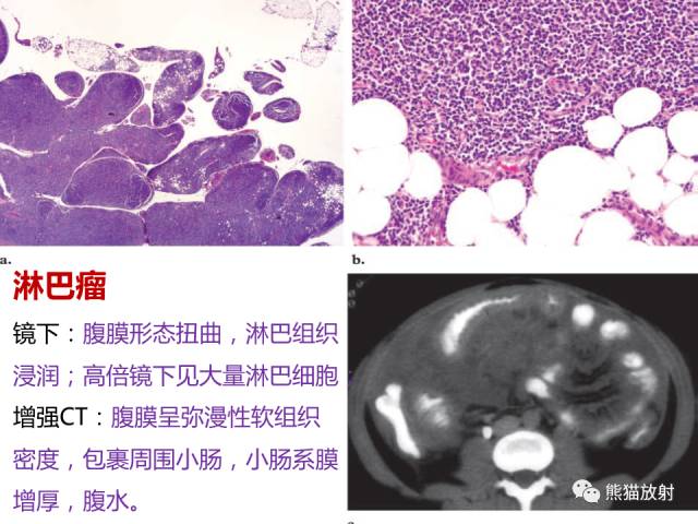 【PPT】腹膜腔继发性肿瘤及肿瘤样病变影像表现