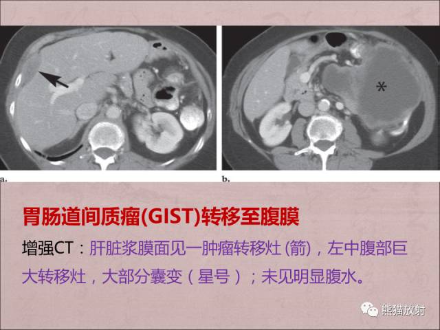 【PPT】腹膜腔继发性肿瘤及肿瘤样病变影像表现