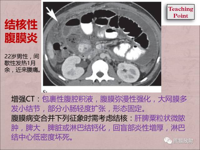 【PPT】腹膜腔继发性肿瘤及肿瘤样病变影像表现