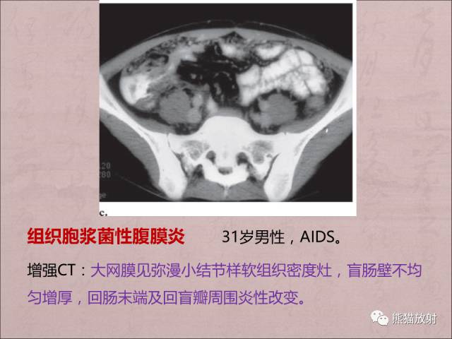 【PPT】腹膜腔继发性肿瘤及肿瘤样病变影像表现