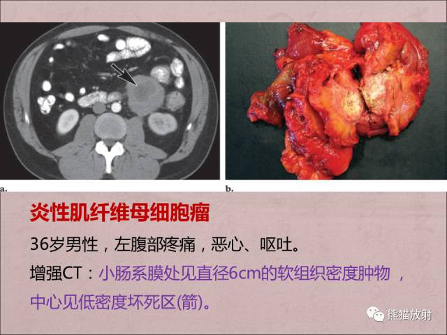 【PPT】腹膜腔继发性肿瘤及肿瘤样病变影像表现