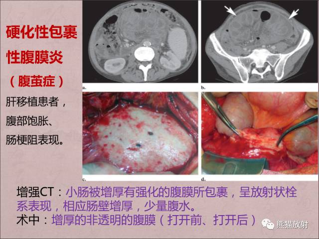 【PPT】腹膜腔继发性肿瘤及肿瘤样病变影像表现