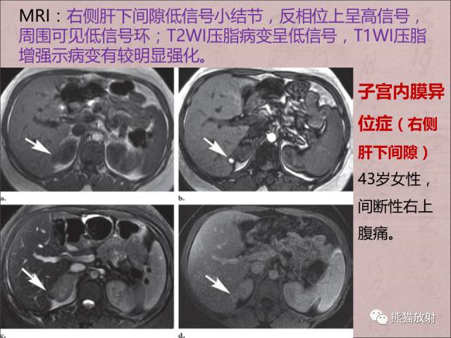 【PPT】腹膜腔继发性肿瘤及肿瘤样病变影像表现
