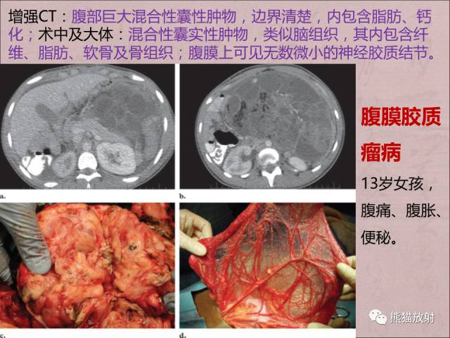 【PPT】腹膜腔继发性肿瘤及肿瘤样病变影像表现