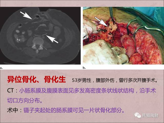 【PPT】腹膜腔继发性肿瘤及肿瘤样病变影像表现