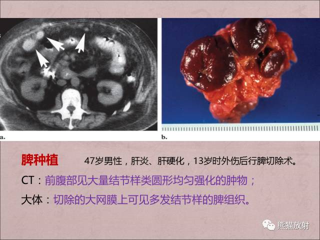 【PPT】腹膜腔继发性肿瘤及肿瘤样病变影像表现