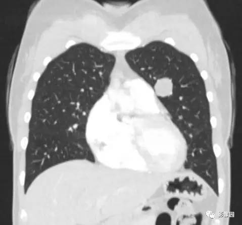 【病例】左肺上叶错构瘤1例CT影像表现 【病例】左肺上叶错构瘤1例CT影像表现