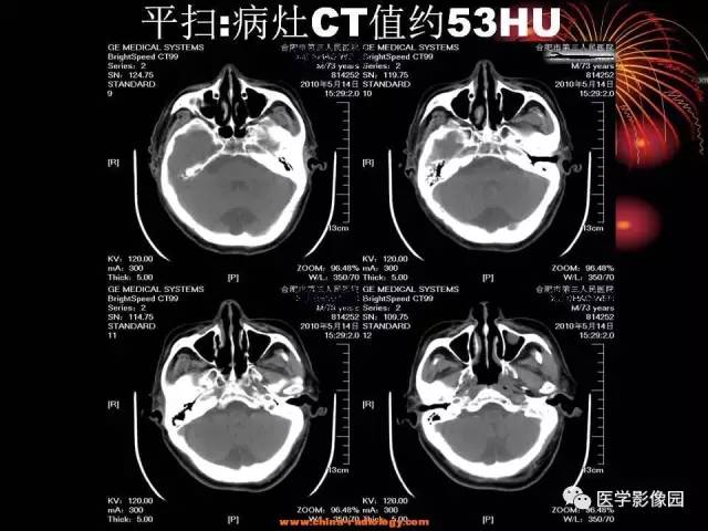 【病例】口咽、舌根鳞癌1例CT影像表现