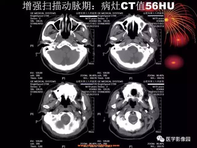 【病例】口咽、舌根鳞癌1例CT影像表现