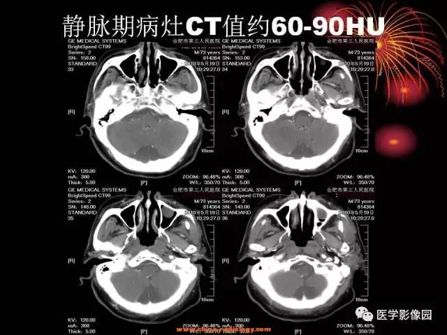 【病例】口咽、舌根鳞癌1例CT影像表现