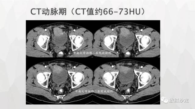 【病例】膀胱淋巴瘤1例CT及MR影像表现 【病例】膀胱淋巴瘤1例CT及MR影像表现