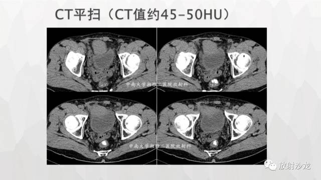 【病例】膀胱淋巴瘤1例CT及MR影像表现