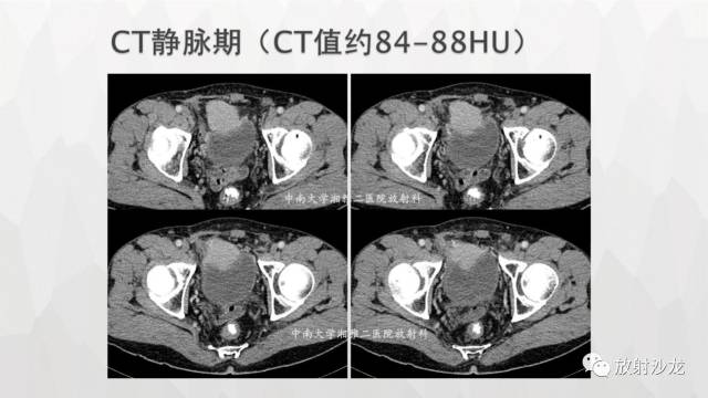 【病例】膀胱淋巴瘤1例CT及MR影像表现 【病例】膀胱淋巴瘤1例CT及MR影像表现
