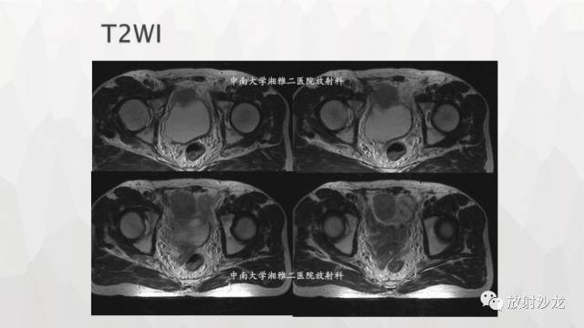 【病例】膀胱淋巴瘤1例CT及MR影像表现 【病例】膀胱淋巴瘤1例CT及MR影像表现
