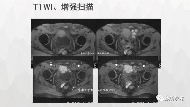 【病例】膀胱淋巴瘤1例CT及MR影像表现 【病例】膀胱淋巴瘤1例CT及MR影像表现