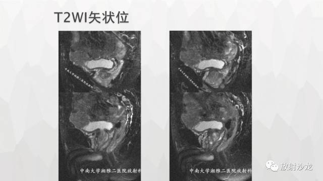 【病例】膀胱淋巴瘤1例CT及MR影像表现 【病例】膀胱淋巴瘤1例CT及MR影像表现