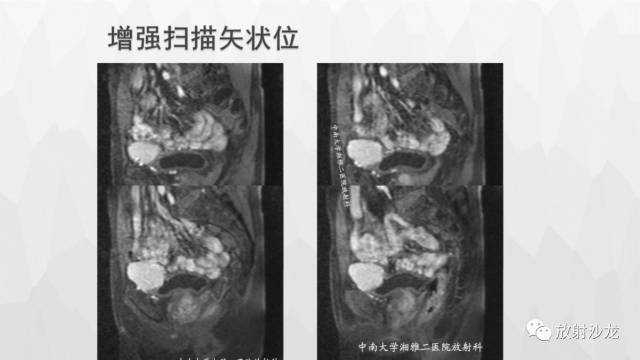 【病例】膀胱淋巴瘤1例CT及MR影像表现 【病例】膀胱淋巴瘤1例CT及MR影像表现