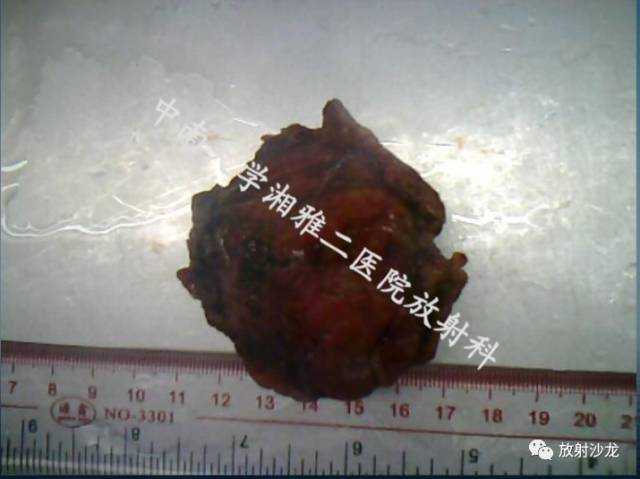 【病例】膀胱淋巴瘤1例CT及MR影像表现 【病例】膀胱淋巴瘤1例CT及MR影像表现