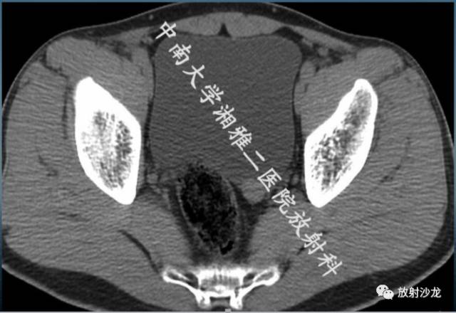 【病例】膀胱淋巴瘤1例CT及MR影像表现 【病例】膀胱淋巴瘤1例CT及MR影像表现