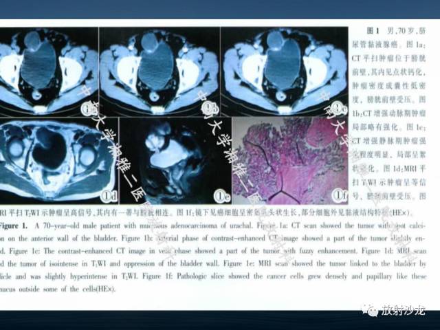 【病例】膀胱淋巴瘤1例CT及MR影像表现 【病例】膀胱淋巴瘤1例CT及MR影像表现
