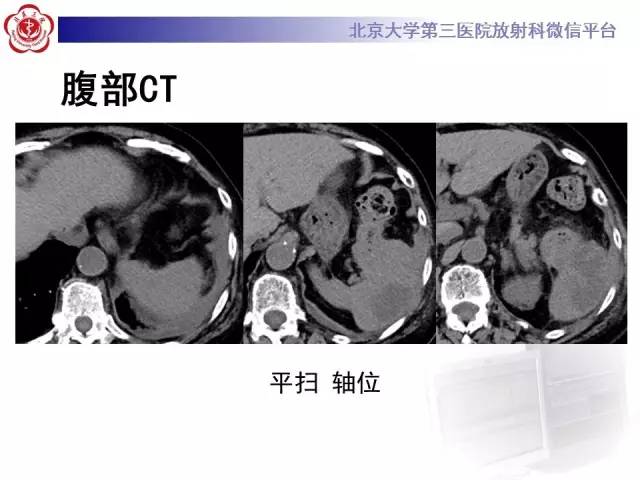 【病例】结肠癌继发脾脏脓肿1例CT