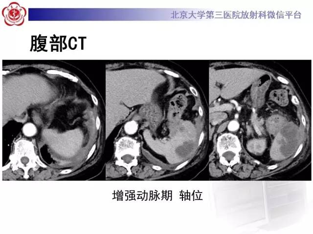 【病例】结肠癌继发脾脏脓肿1例CT